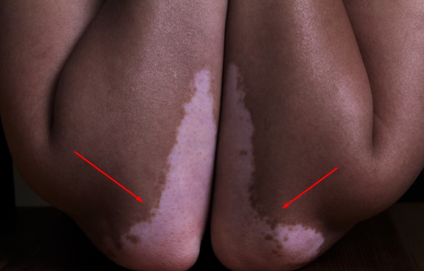 Best Hospital In Chennai For Vitiligo Treatment.jpg