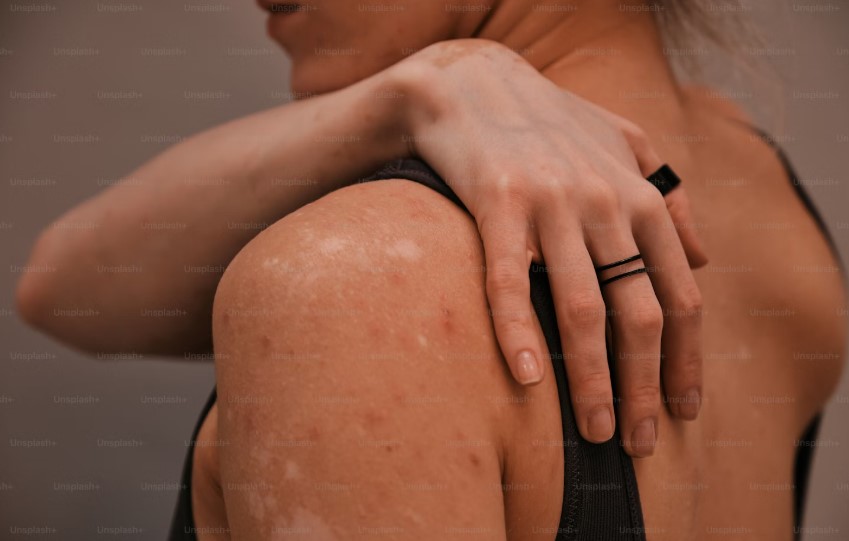 Best Hospital In Kolkata For Vitiligo Treatment.jpg