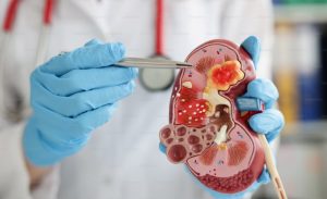 Best Hospital In Chennai For Kidney Stone Treatment.jpg